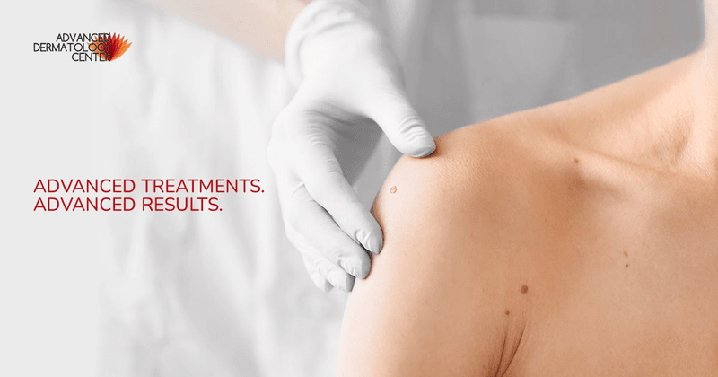 Advanced Dermatology Center