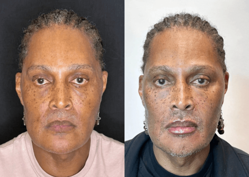 ANTI | The Art of Injections