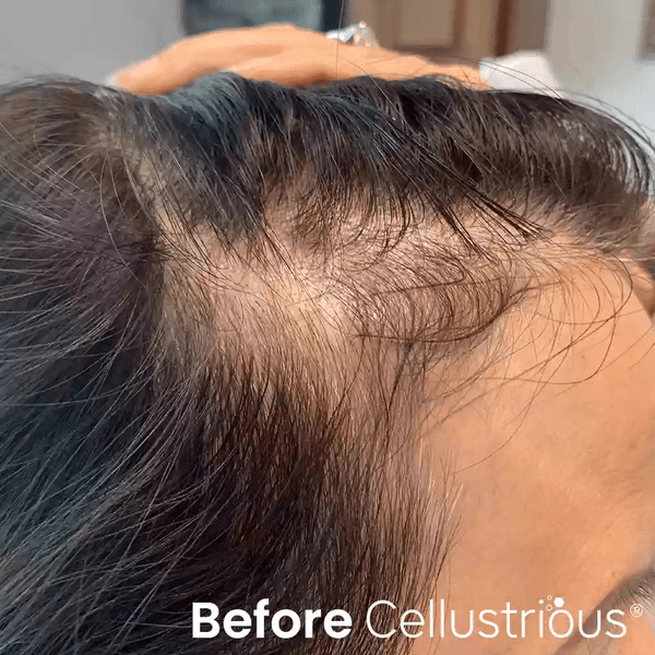 Cellustrious Hair & Skin Rejuvenation