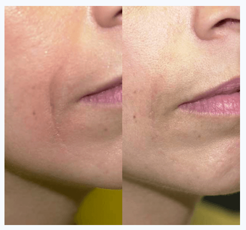 Dermal Fillers Botox La Jolla