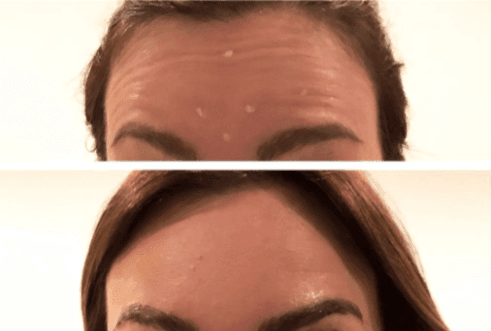 Diamond Dermis