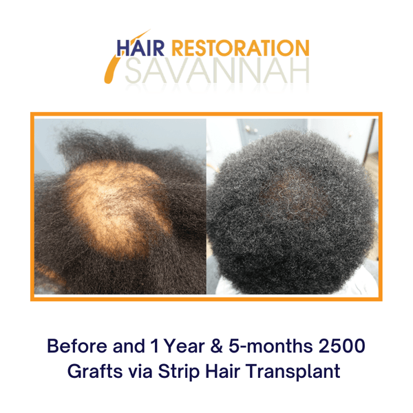 Hair Restoration Savannah