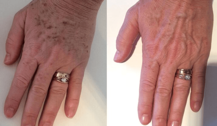 Huntington Harbour Laser