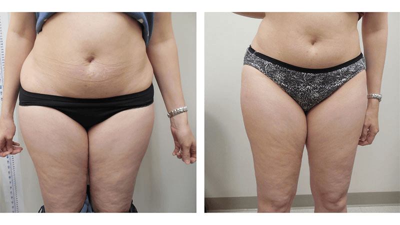 Laser Body Renewal of Wilton