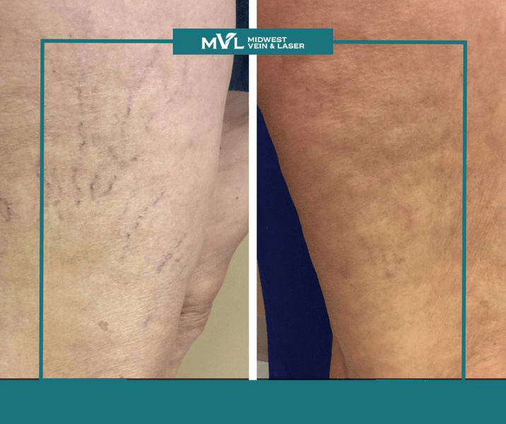 Midwest Vein and Laser