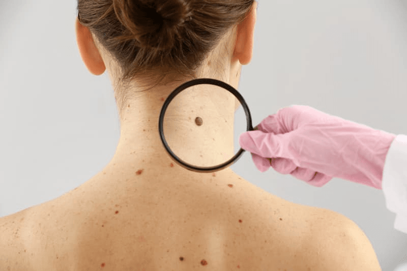 Mole Removal Orange County