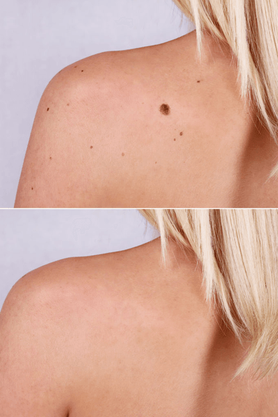 Mole Removal Orange County