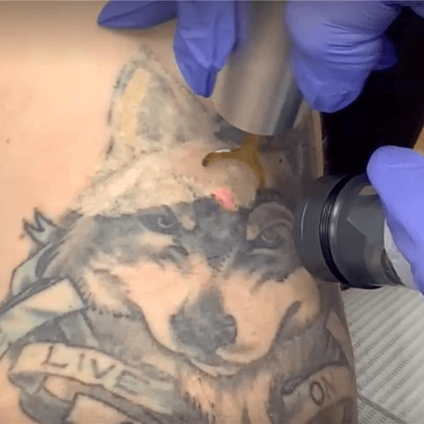 Tattoo Removal in Baltimore, MD - Towson