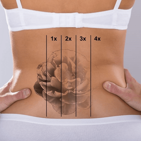 Valley Tattoo Removal