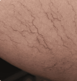 Vein Center of Idaho